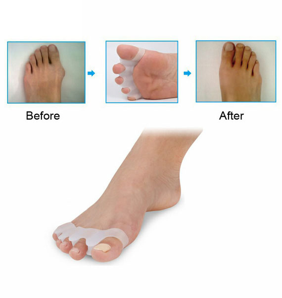 脚趾外翻分趾硅胶矫正器